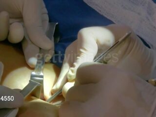 Aj sotavento desde wwe consigue su third pecho implant: gratis adulto película 8e